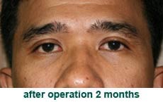 plastic-surgery-blepharoplasty